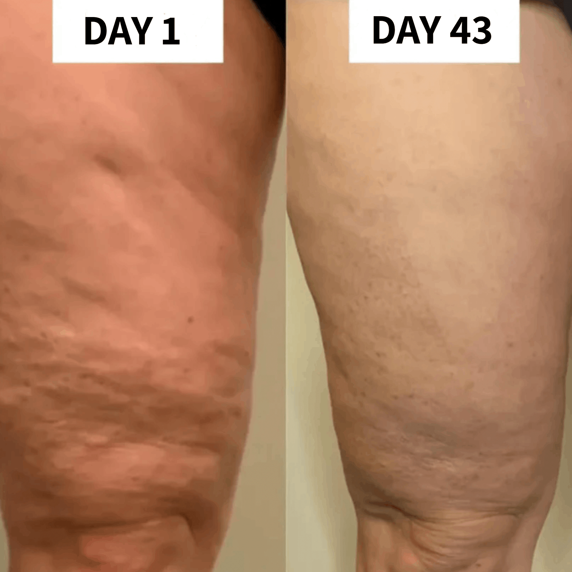 Cellulite Removal Wand - Mavens Deals